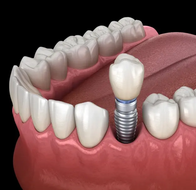 3D illustration of a dental implant in the jawbone between natural teeth.